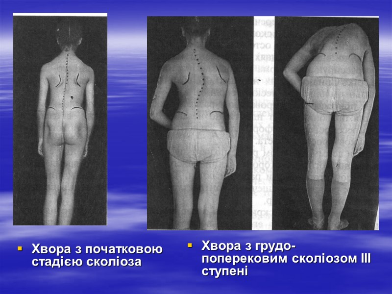 Хвора з початковою стадією сколіоза Хвора з грудо-поперековим сколіозом ІІІ ступені